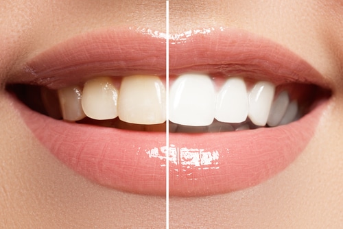 ¿Qué es el blanqueamiento dental?
