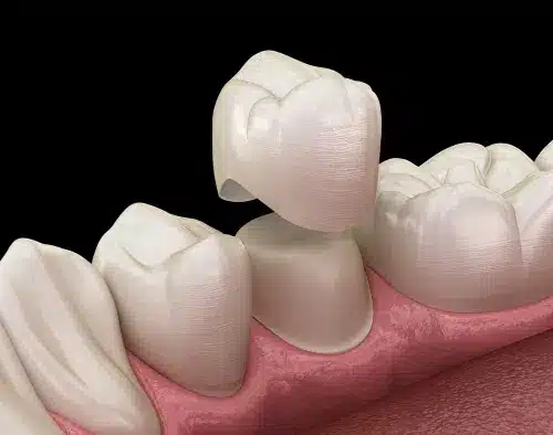 What Is a Dental Crown