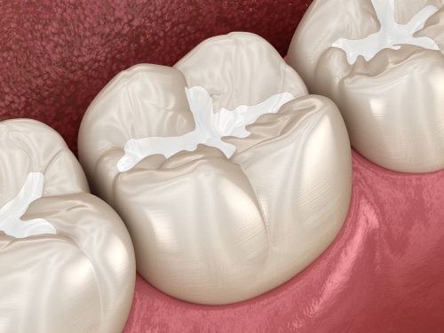 Dental Fillings in Butler, PA Brockley Dental Center Mini Dental Implants