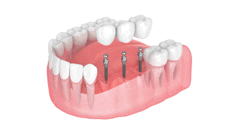 Puentes dentales en Butler, PA Brockley Dental Center Mini Implantes Dentales