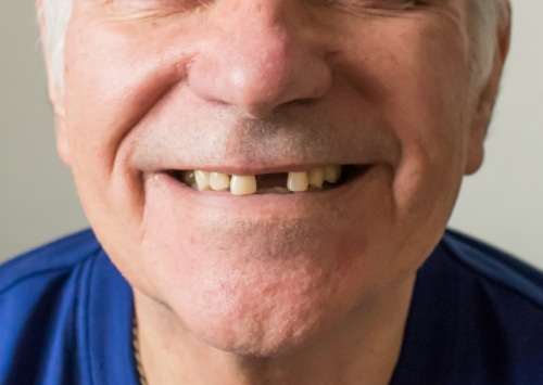 Dental Implants Brockley Dental Center Mini Dental Implants in Butler PA