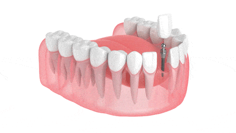 Implantes Dentales | Brockley Dental Center | Mini Implantes Dentales en Butler, PA
