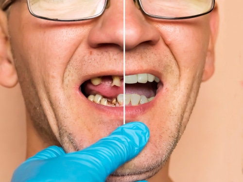 Full Mouth Reconstruction in Butler, PA Brockley Dental Center Mini Dental Implants