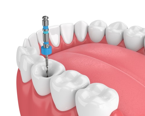 Endodoncia en Butler, PA Brockley Dental Center Mini Implantes Dentales