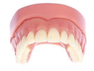 Removable Acrylic Overdenture