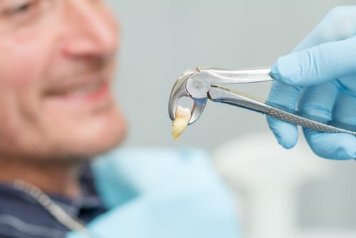What Is a Tooth Extraction