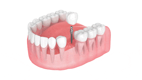 Mini Implantes Dentales en Butler, PA Brockley Dental Center