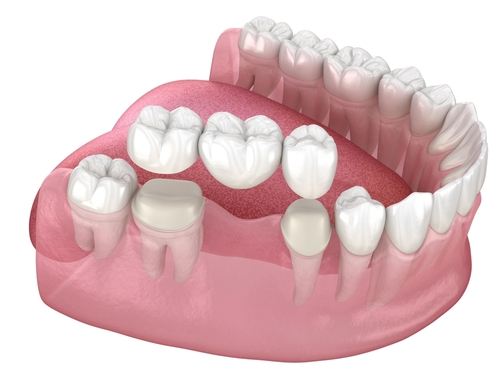 Restorative Dentistry in Butler, PA | Dental Bridge Treatment