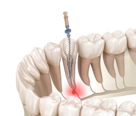 Restorative Dentistry in Butler, PA | Root Canal Treatment