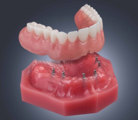 Estabilización de prótesis con miniimplantes dentales Prótesis sobre implantes