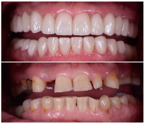 Full Mouth Restoration Restoring Your Smile With Mini Implants