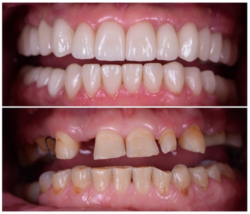 Restauración de toda la boca Restaure su sonrisa con miniimplantes