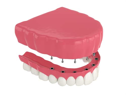 Dentaduras postizas sueltas Consejos para una mayor estabilidad Brockley Dental Center