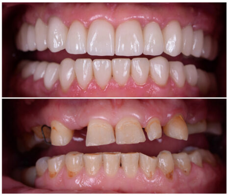 Full Mouth Restoration in Butler, PA | Totally Transform Your Smile