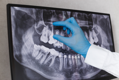 Root Canal Treatment in Butler, PA | Saving Teeth from Extraction