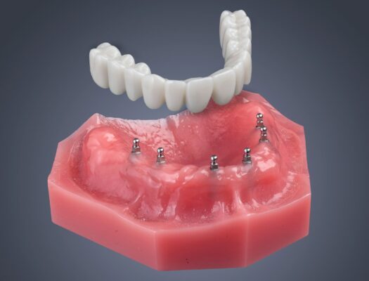 All-on-4®Alternative: Introducing Fix-on-Six® Dental Implants