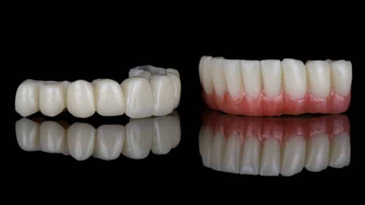 Dental Roundhouse Bridge in Butler, PA | Fixed Denture Solutions