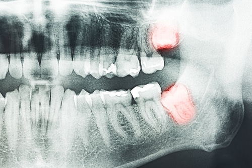 Wisdom Teeth Extractions in Butler, PA | Brockley Dental Center