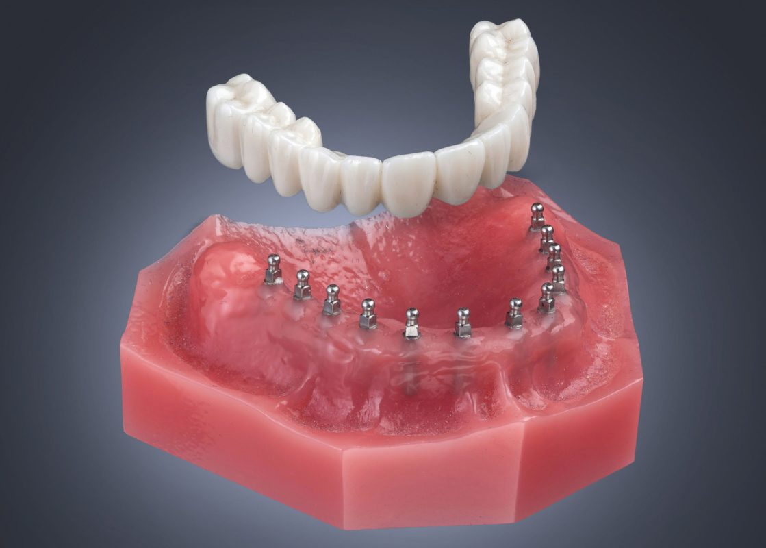 Mini Dentaduras en Butler, PA | Implantes Dentales | Reemplazo de Dientes