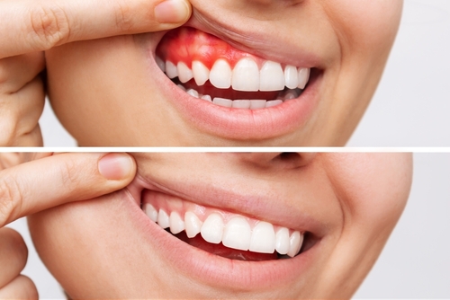 Reverse Gum Disease | Periodontitis Symptoms and Treatment