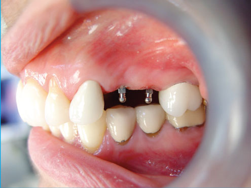 Implantes Dentales en Butler, PA | Mini Implantes Dentales | Dr. Brockley