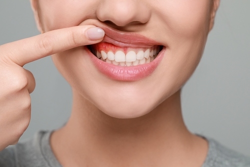 Reverse Gum Disease in Butler, PA | Protect Your Oral Health!