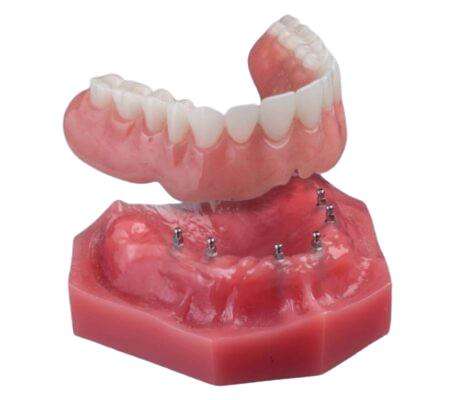 Dentaduras Snap-In en Butler, PA | Dentadura Mini Implant Supported