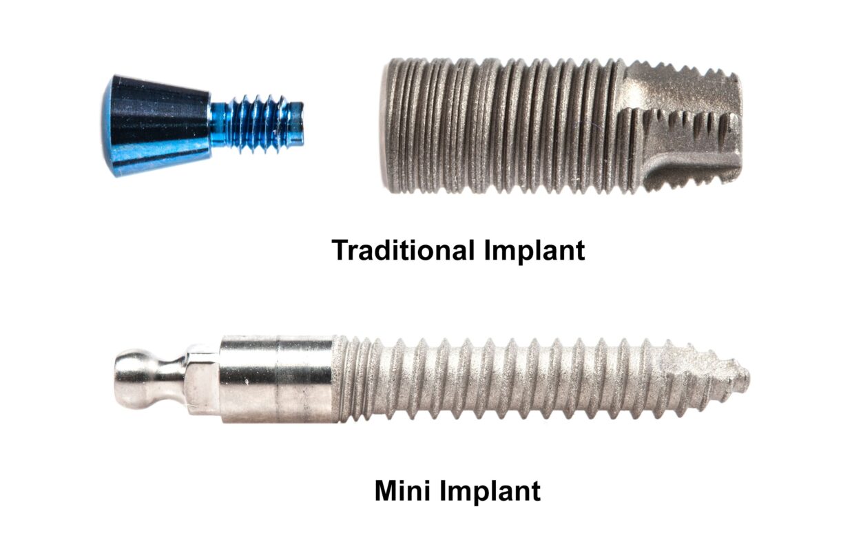 In Butler, PA, dental implants and mini implants are restoring smiles, one tooth at a time. Contact Brockley Dental Center to learn more!