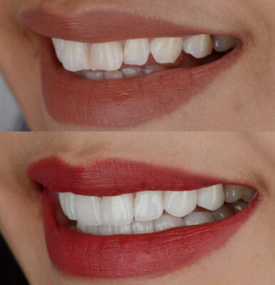 Dental Veneers in Pittsburgh, PA | Transform Your Smile Today