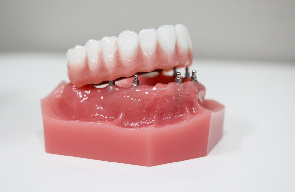 Implant Retained Dentures in Butler, PA | Secure Loose Dentures