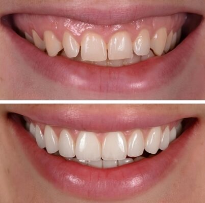 Veneer Dentist in Butler, PA | Transform Your Smile With Veneers