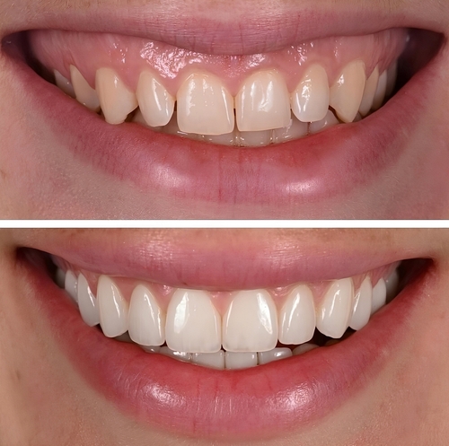 Veneer Dentist in Butler, PA | Transform Your Smile With Veneers