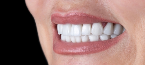 Permanent Teeth Whitening in Butler, PA | Brighten Your Smile