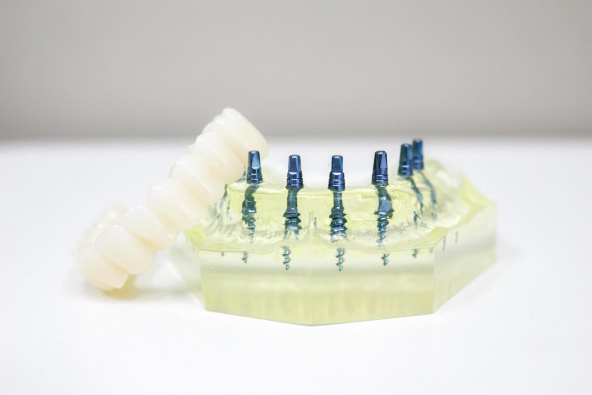 All-on-6 Alternatives in Butler, PA | Restore Your Smile Comfortably