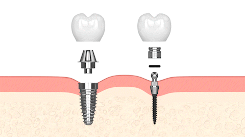 All-on-6 Alternatives in Butler, PA | Restore Your Smile Comfortably