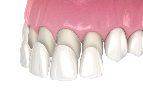 Veneers vs. Bonding in Butler, PA | Enhance Your Smile Today