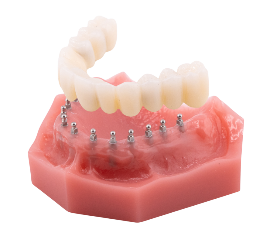 Roundhouse Bridge | Implant Dentures in Butler, PA | Brockley Dental Center