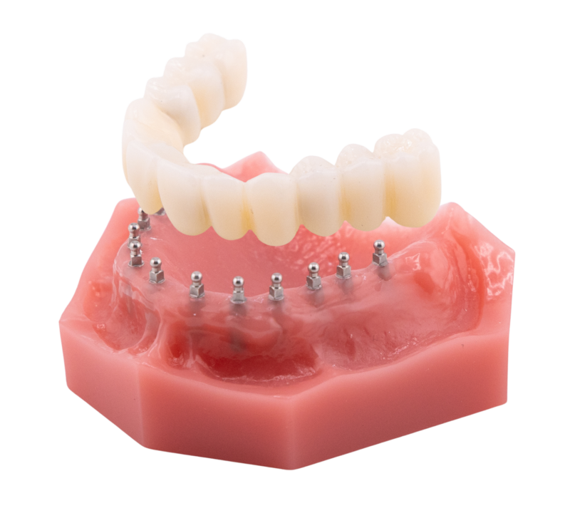 Roundhouse Bridge | Implant Dentures in Butler, PA | Brockley Dental Center