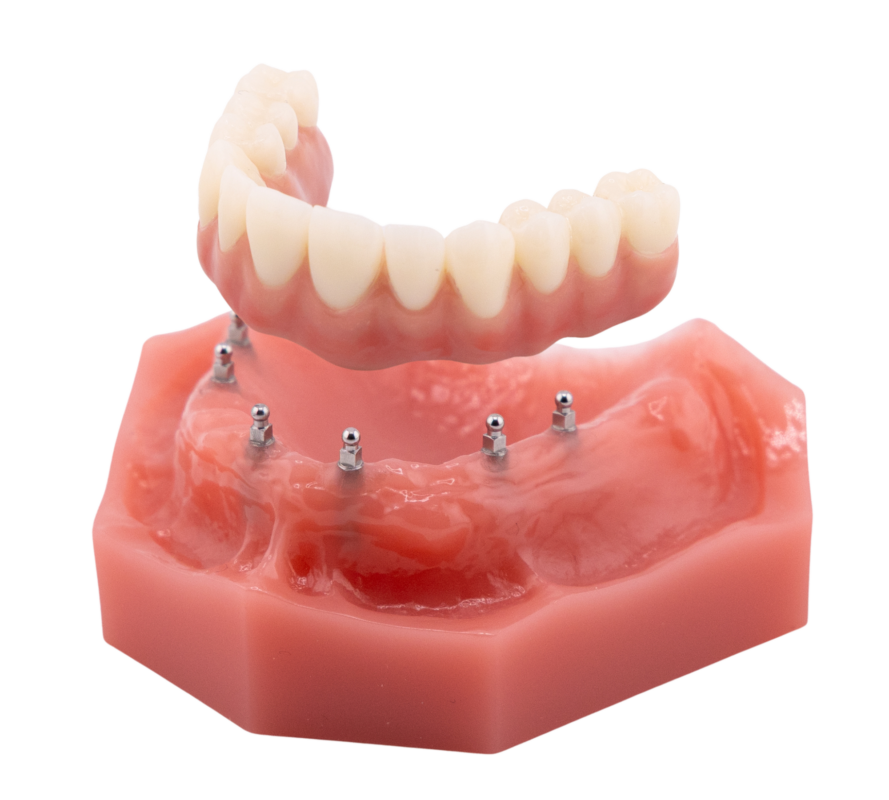 All on Four | Implant Dentures in Butler, PA | Brockley Dental Center