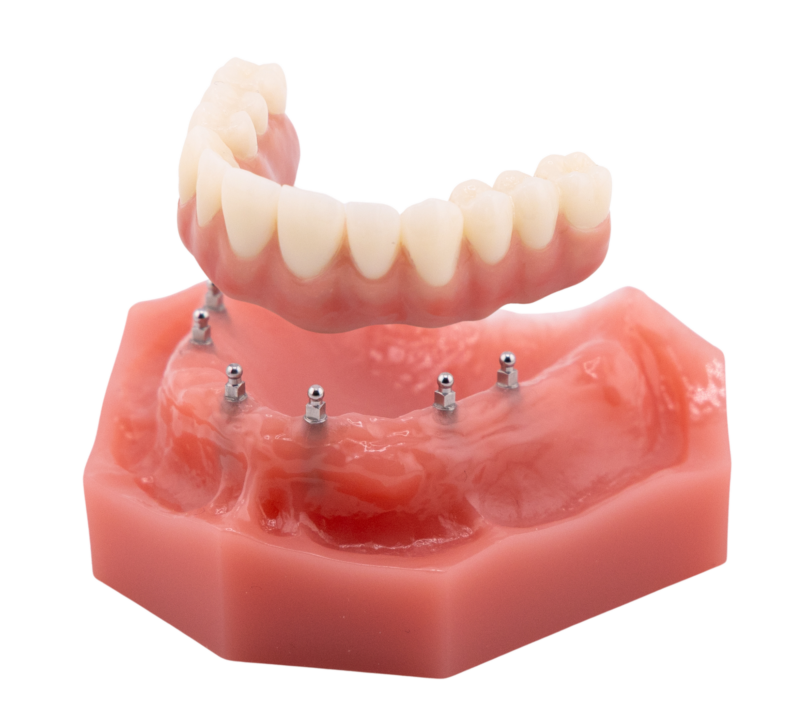 All on Four | Implant Dentures in Butler, PA | Brockley Dental Center