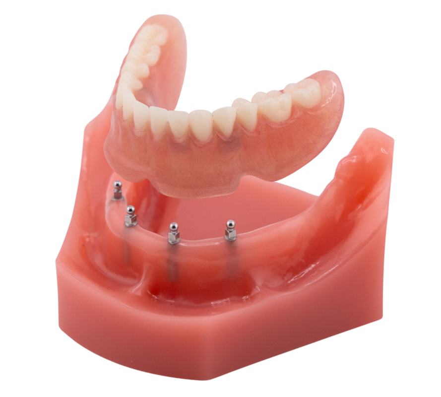 All on Four | Implant Dentures in Butler, PA | Brockley Dental Center