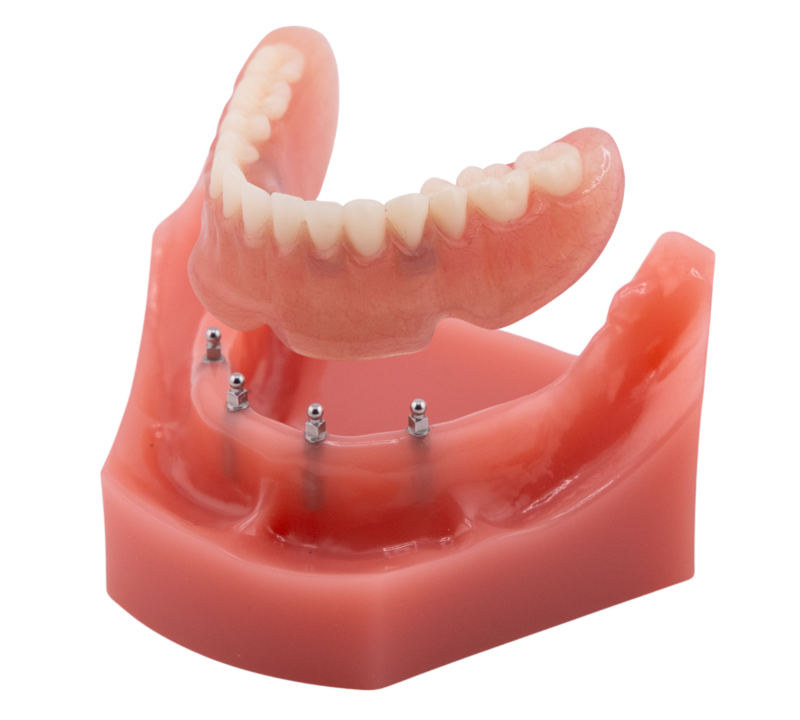 All on Four | Implant Dentures in Butler, PA | Brockley Dental Center