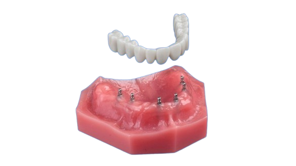 Dental Implant Denture in Butler, PA | Visit Brockley Dental Center!