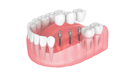 Teeth in a Day in Butler, PA | The Convenience of Mini Implants