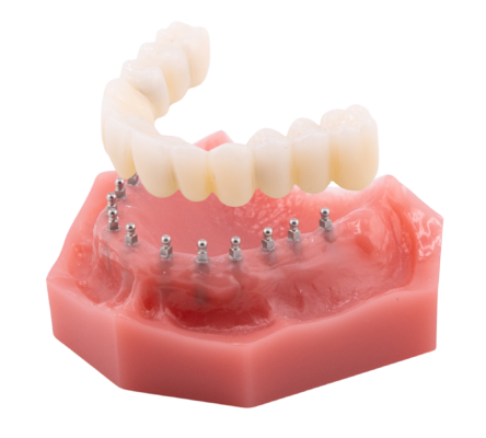 Permanent Dentures in Butler, PA | Discover Mini Implant Solutions