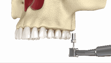 Sinus Lift in Butler, PA | Indirect Sinus Lift Procedure