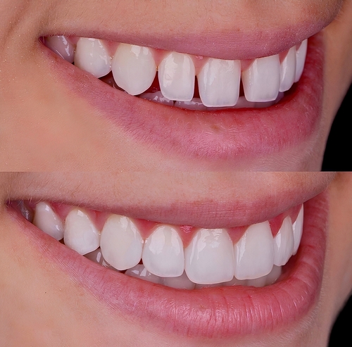 Veneers Cost Pittsburgh | Revitalize Your Smile Affordably