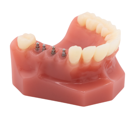 Dental Implants in Butler, PA | Visit Brockley Dental Center Today!