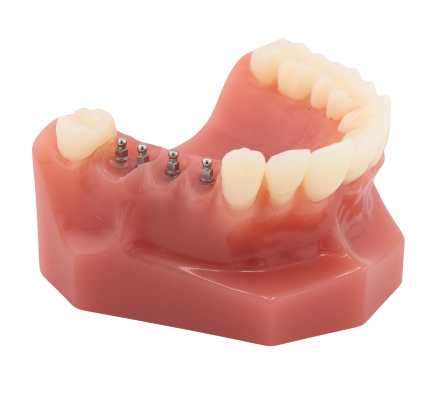 Dental Implants in Butler, PA | Visit Brockley Dental Center Today!