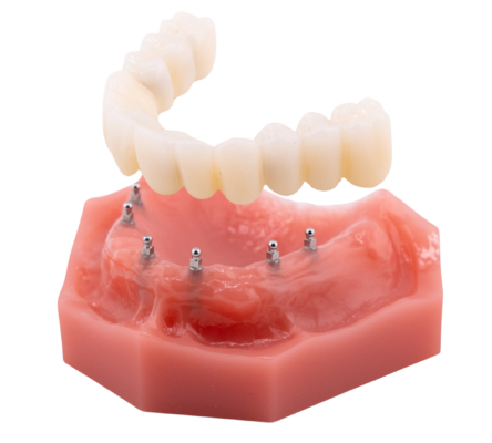 Implant-Retained Dentures in Butler, PA | Book Your Consultation